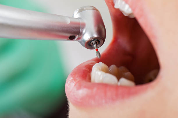 Best Knocked-Out Tooth (Avulsed Tooth) Treatment in Marionville, MO